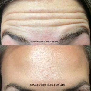 Botox_forehead_pre_post3