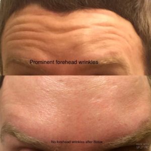 Forehead_pre_post botox on man