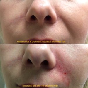 Pre_Post_Nasolabial_dermal__filler