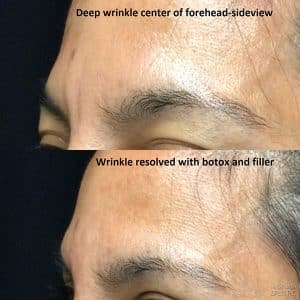 left side wrinkle forhead pre and post botox