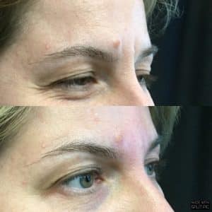 35 yr old woman botox treatment