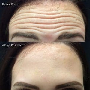 before and after botox treatment