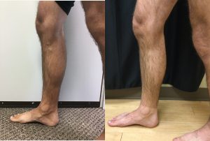 varicose veins sclerotherapy1
