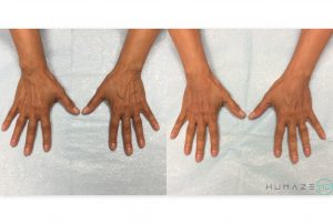69 years old female with prominent vein