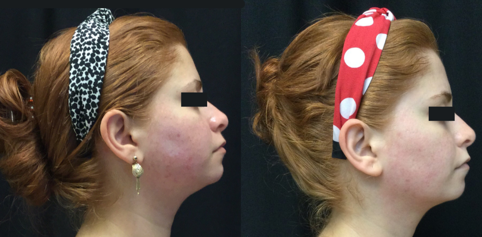 acne scarring treated with PRP microneedling