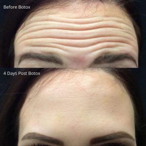 Before and after botox forehead skin