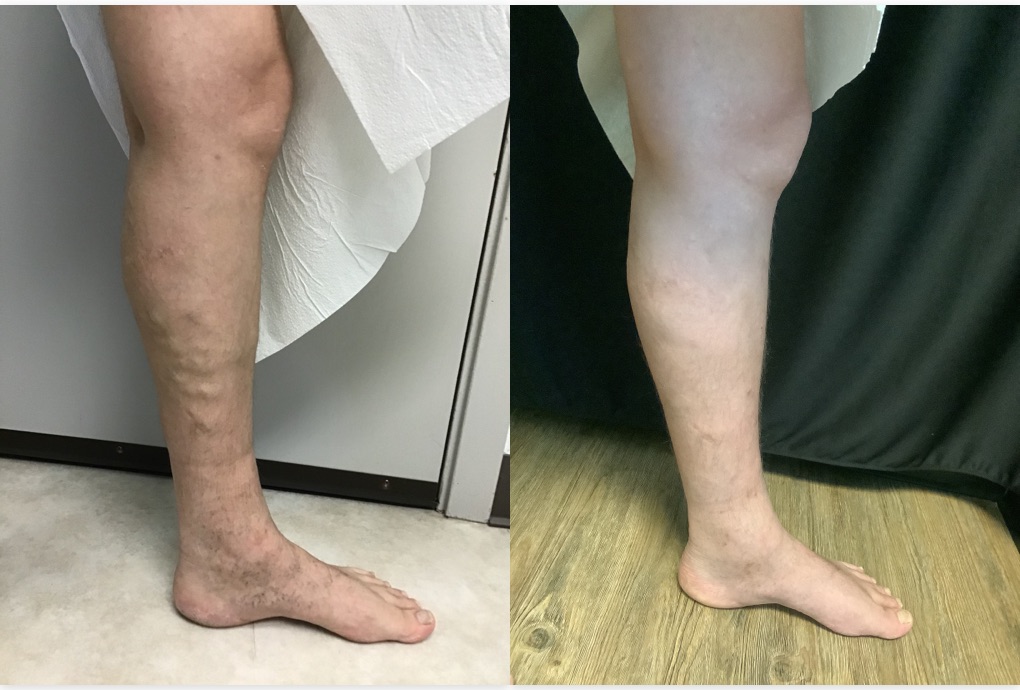 glp 1 and varicose veins Is Treatment for Varicose Veins Covered by Insurance?