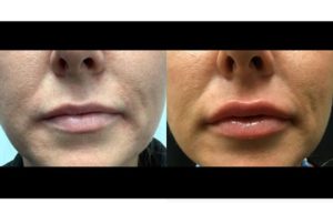 before and after dermal fillers on lips