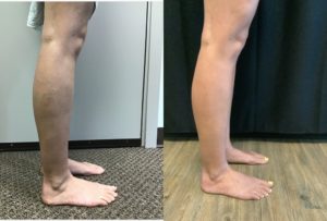 Winkler vein treatment