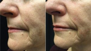 lady pre-post lip filler