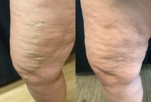 58 yr old female - varicose veins