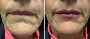 Volbella to smooth out the lip lines