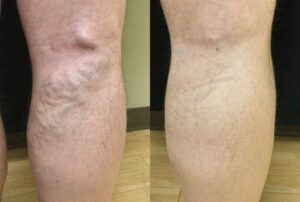 Kerns before and after bakc of leg