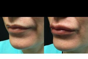 Volbella lip filler in woman