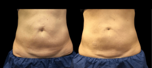 Simone after 2nd cool sculpting procedure