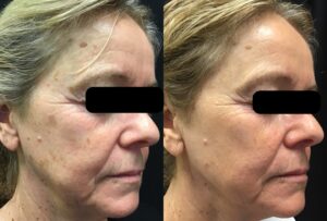 PCA skin care treatment