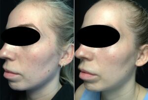 woman before and after IPL treatment