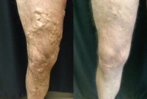 47 yr old male with ropey varicose veins
