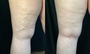 40 years old female with throbbing and leg heaviness